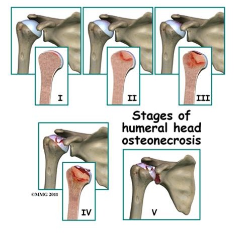 4 Stages Of Avn – Current concepts on osteonecrosis of the femoral head ...